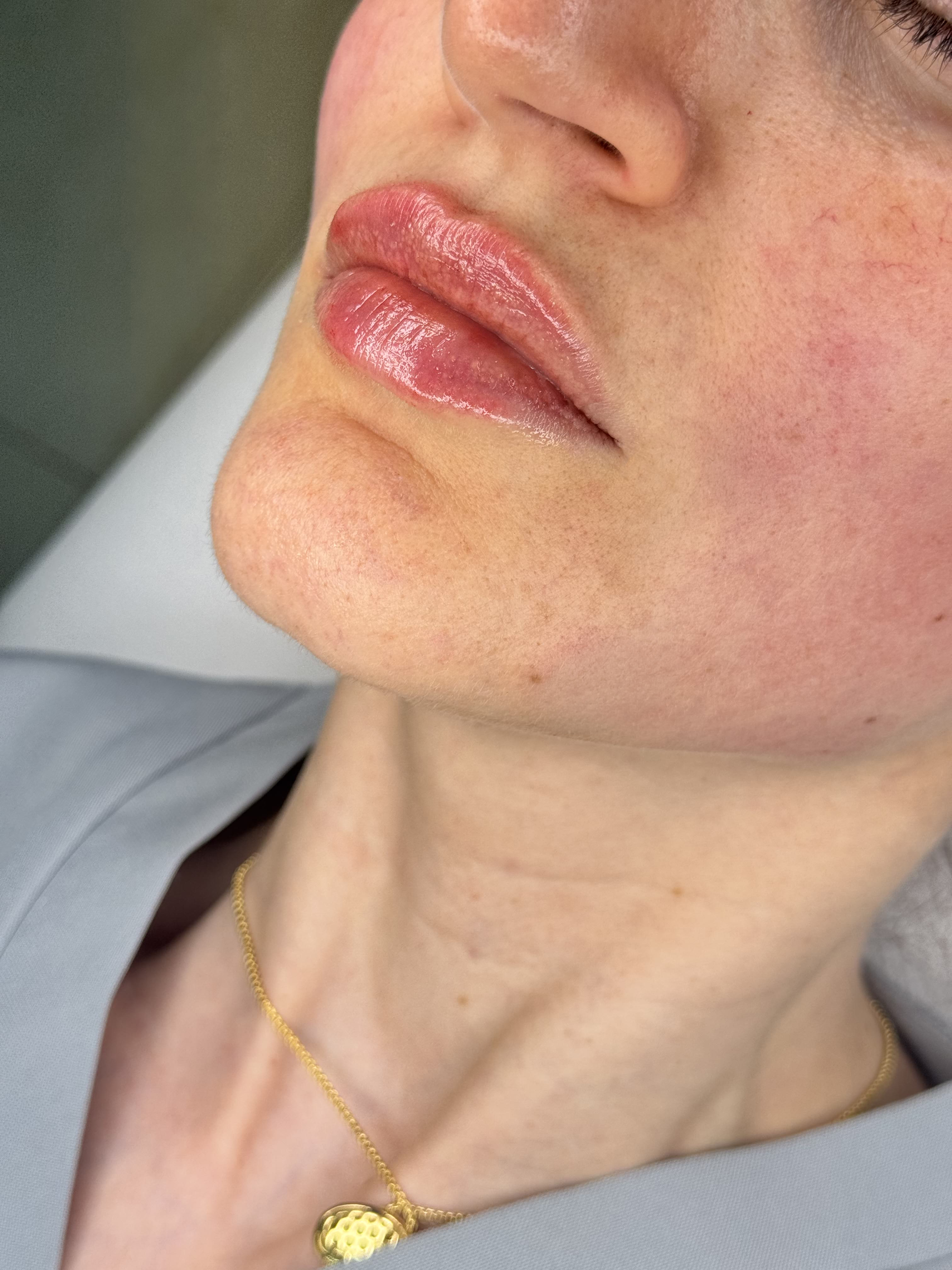 Treatment by Dr. Hadi Salahia