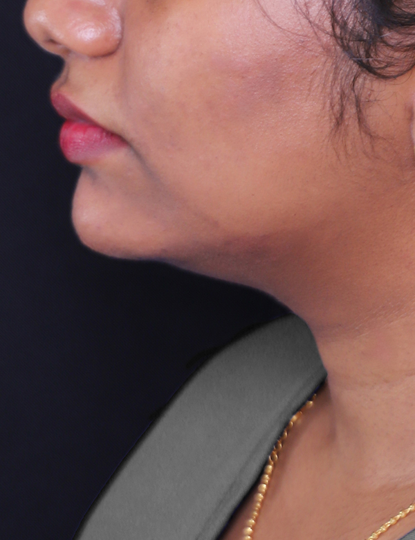 Treatment by Dr. Sami Salahia