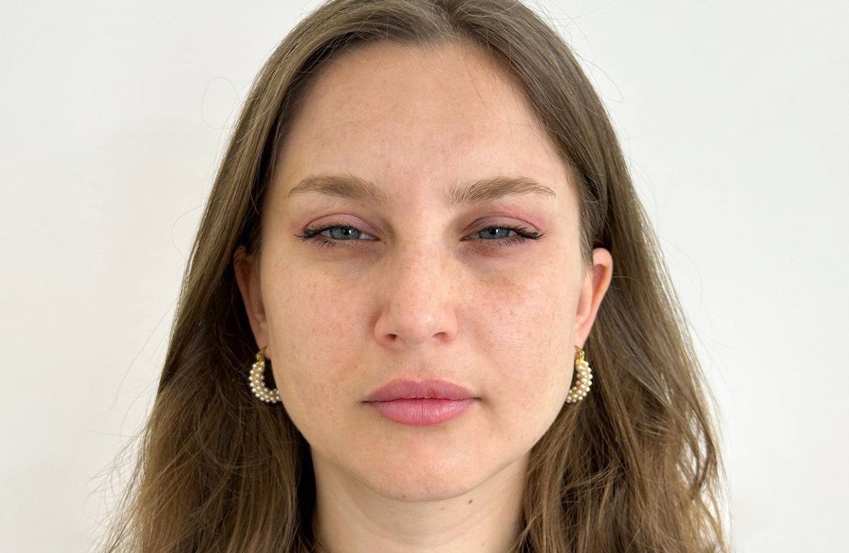 After botox treatment