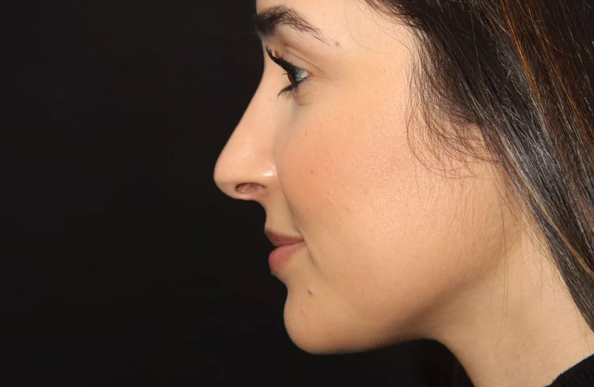 After rhinoplasty treatment