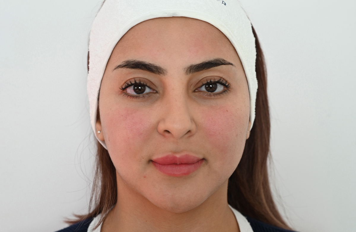 After jovena treatment