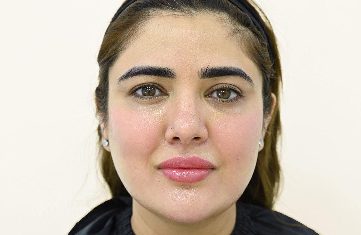 After dermal filler treatment