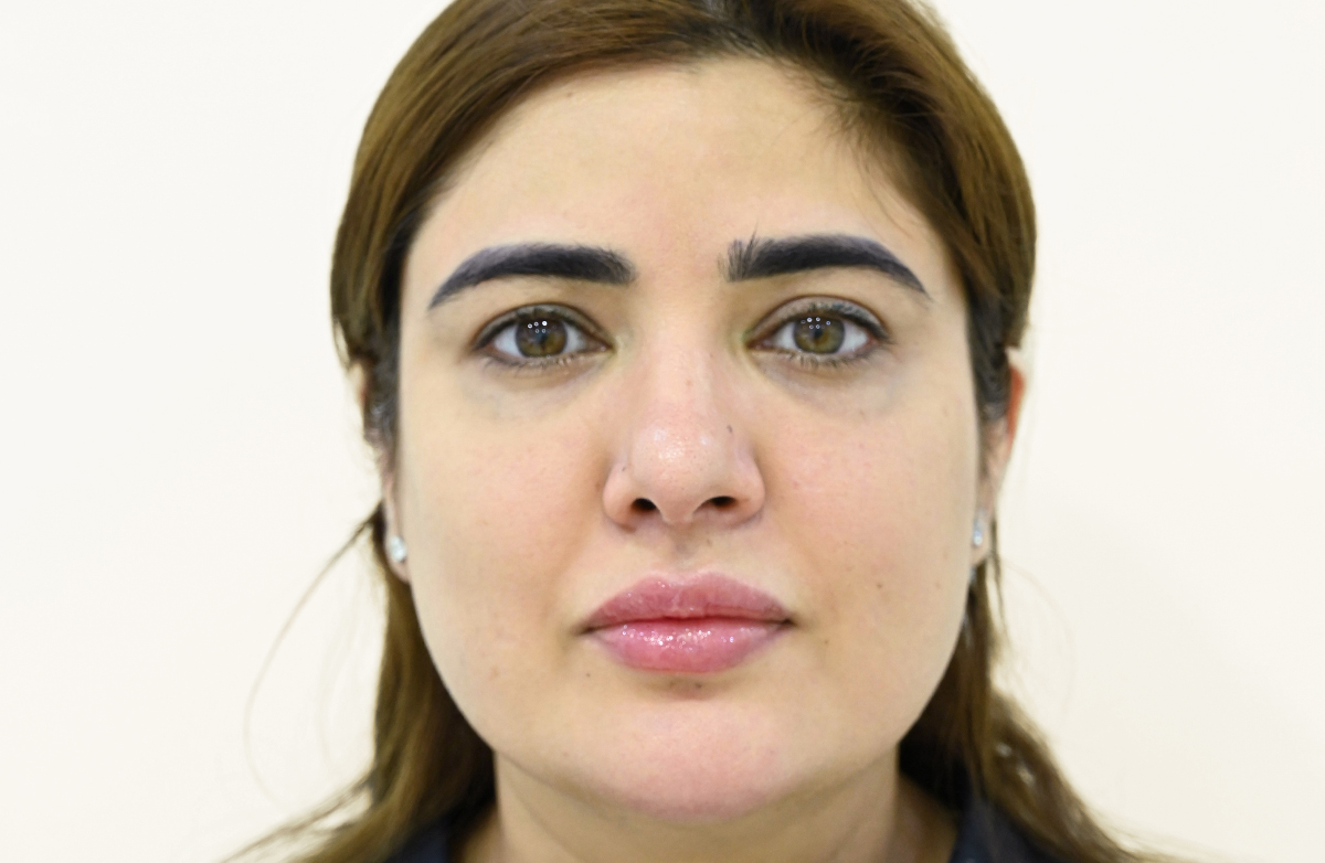 Before dermal filler treatment