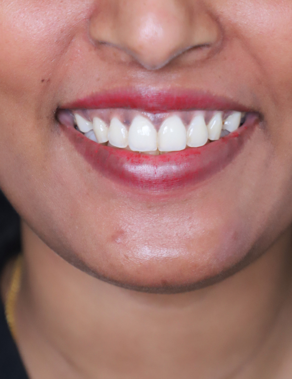 Before gummy smile botox treatment