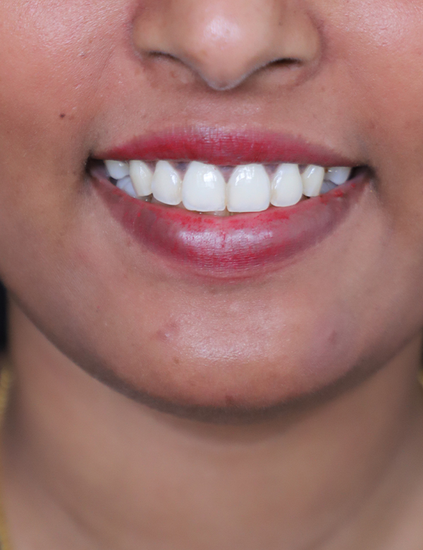 After gummy smile botox treatment