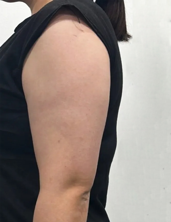 Before onda slimming treatment