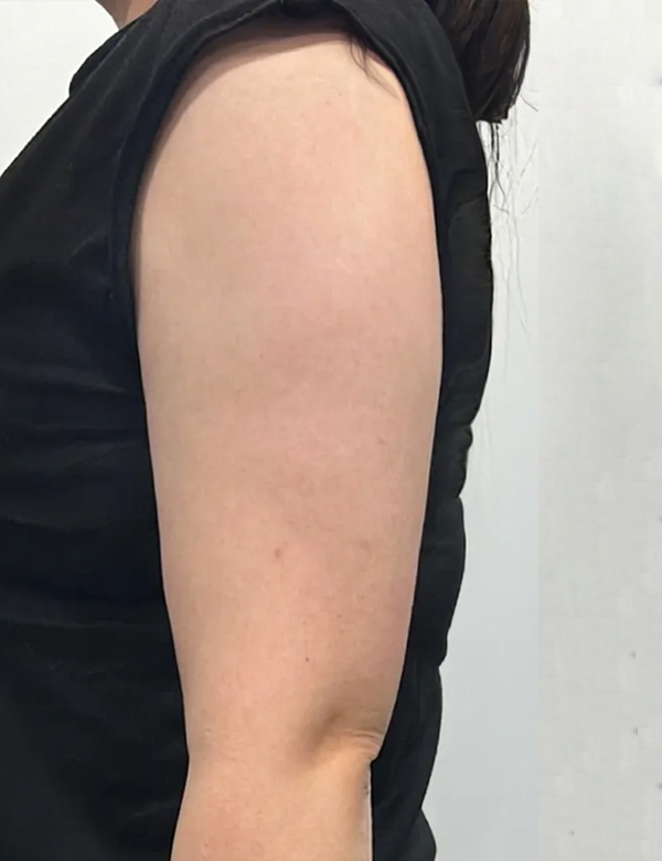 After onda slimming treatment