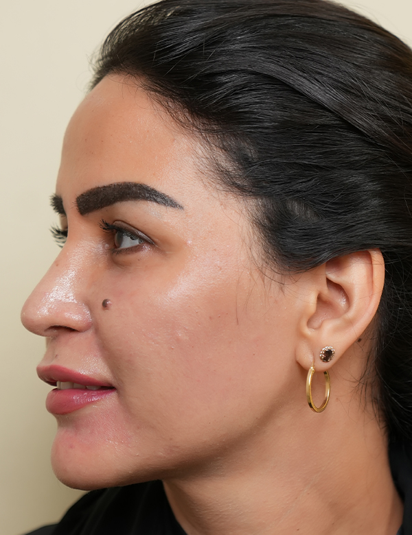 After sofwave lifting treatment