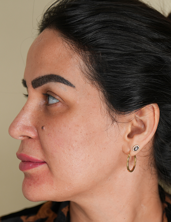Before sofwave lifting treatment