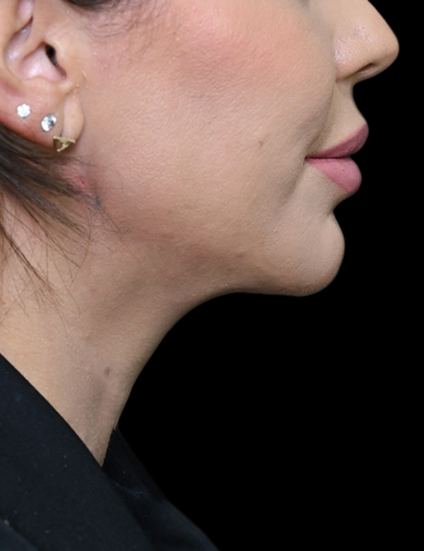 After thread lift treatment
