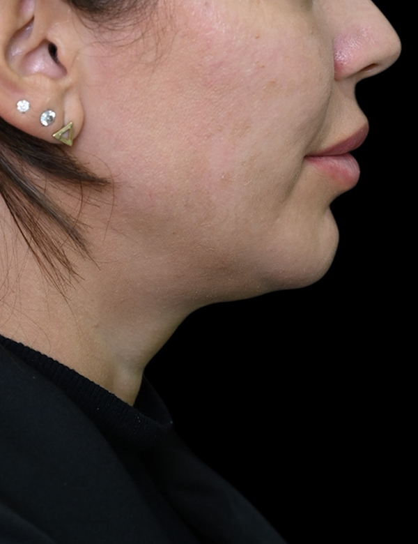 Before thread lift treatment