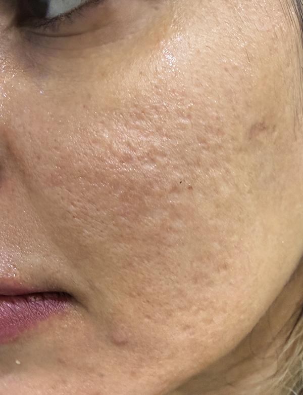 Before rfyne rf microneedling treatment