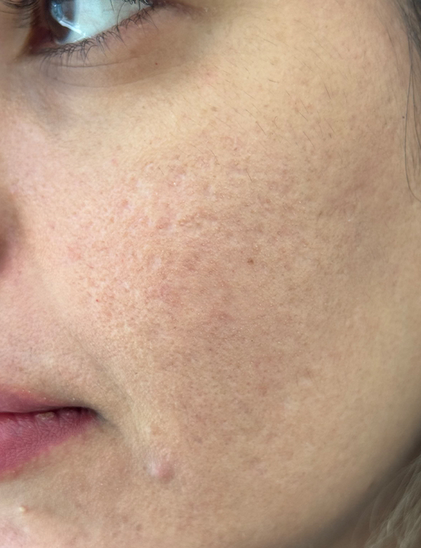 After rfyne rf microneedling treatment