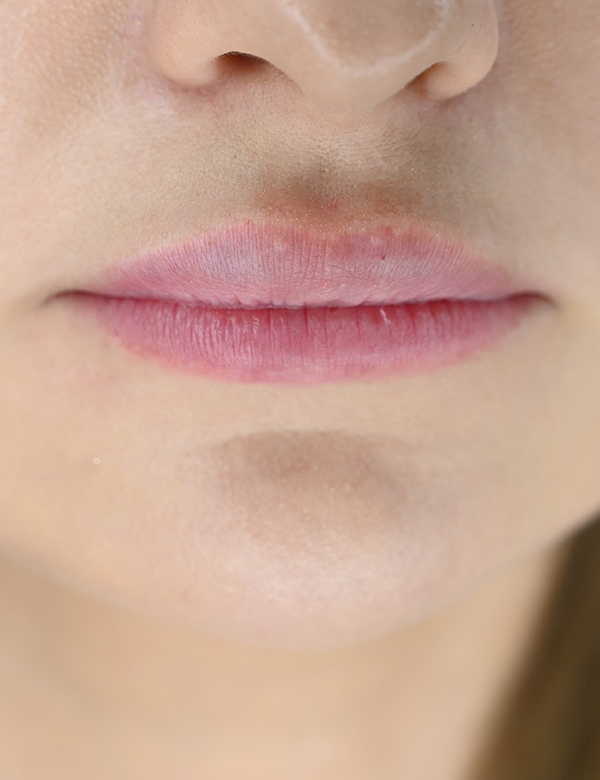 Before lips filler treatment