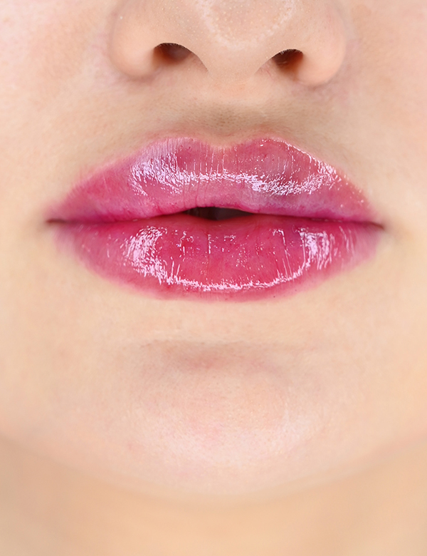 After lips filler treatment