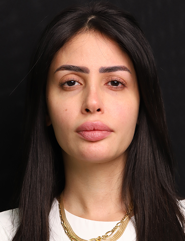 Before dermal filler & lip booster treatment