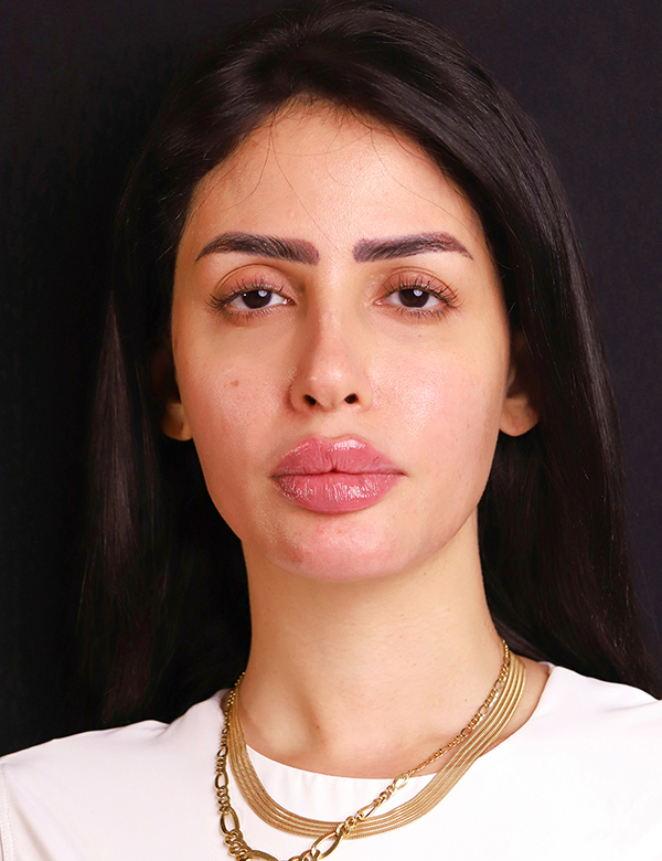 After dermal filler & lip booster treatment
