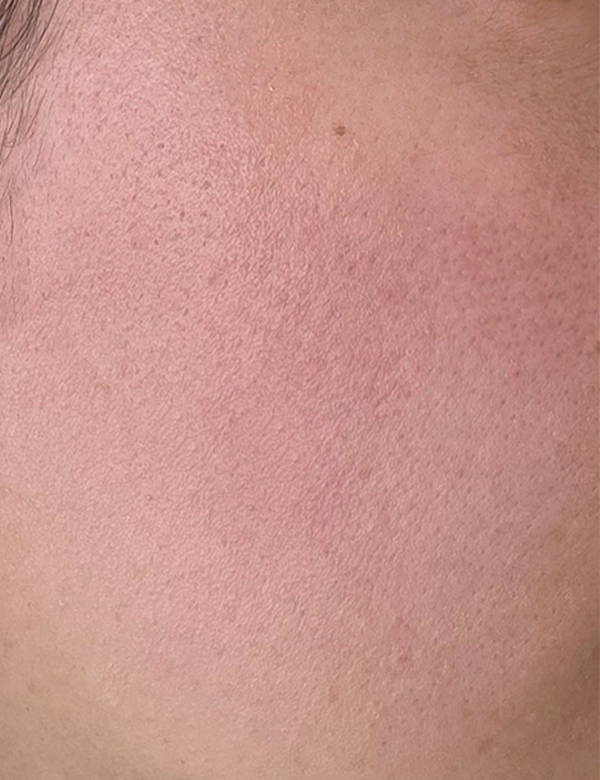 After chemical peel treatment