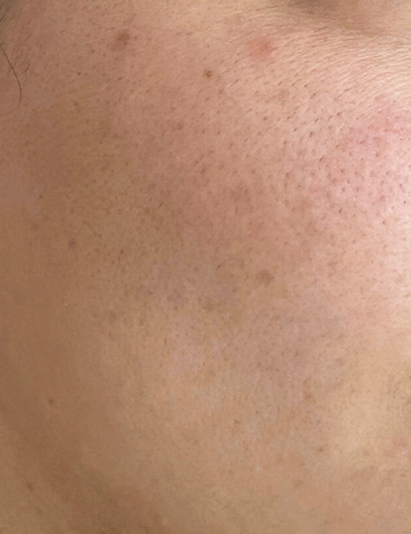 Before chemical peel treatment