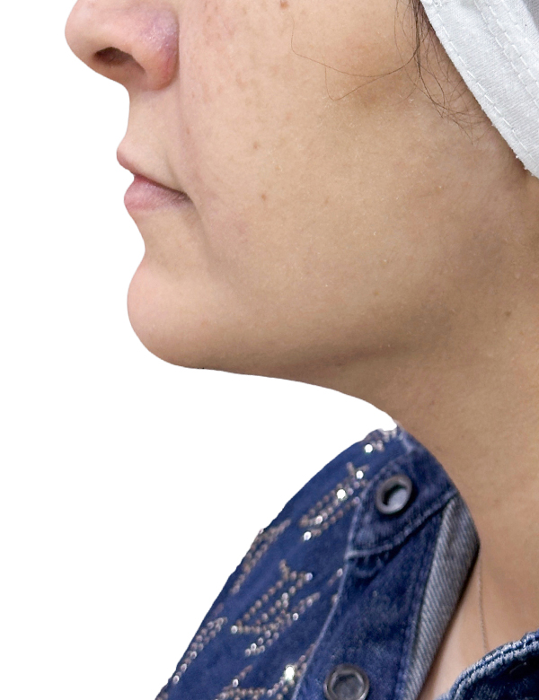 After liposuction treatment