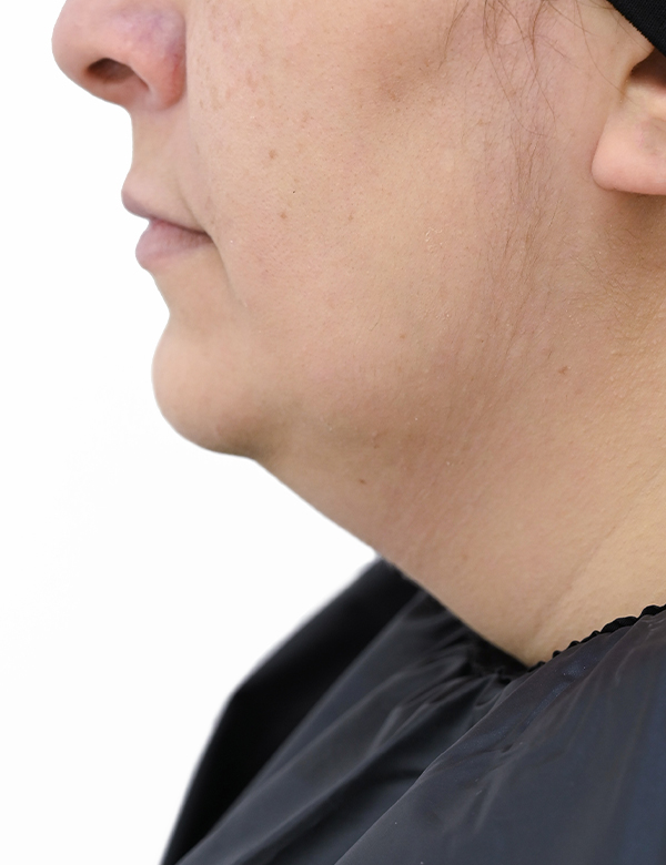 Before liposuction treatment