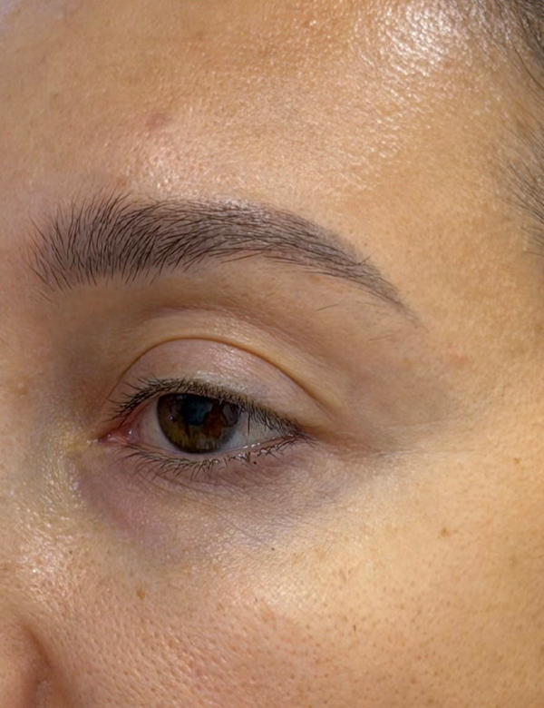 Before brow lift treatment
