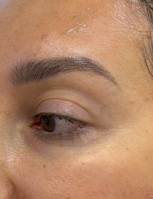 After brow lift treatment