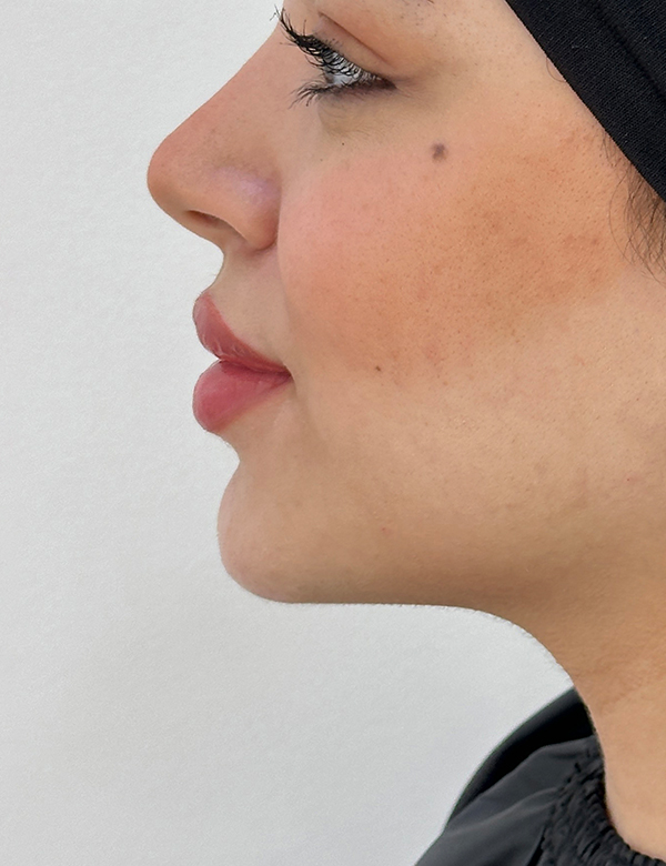 After chin filler treatment