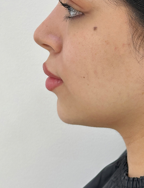 Before chin filler treatment