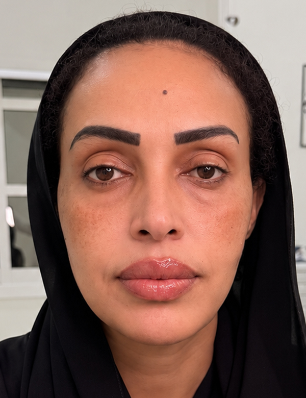 After dermal fillers treatment