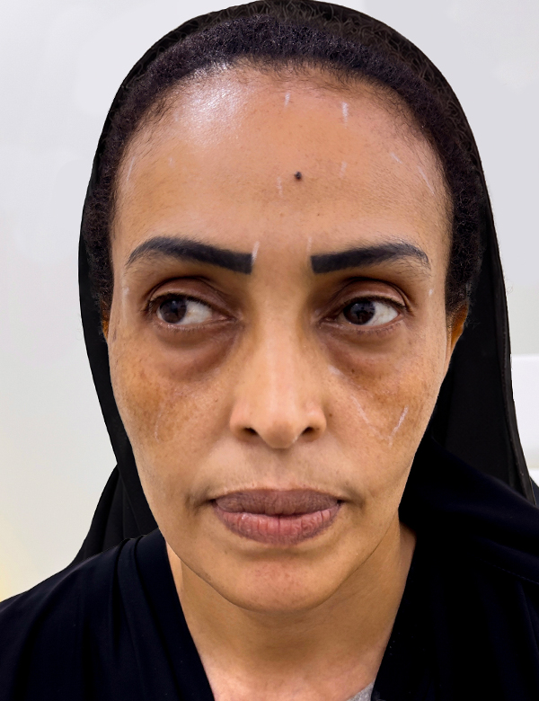 Before dermal fillers treatment