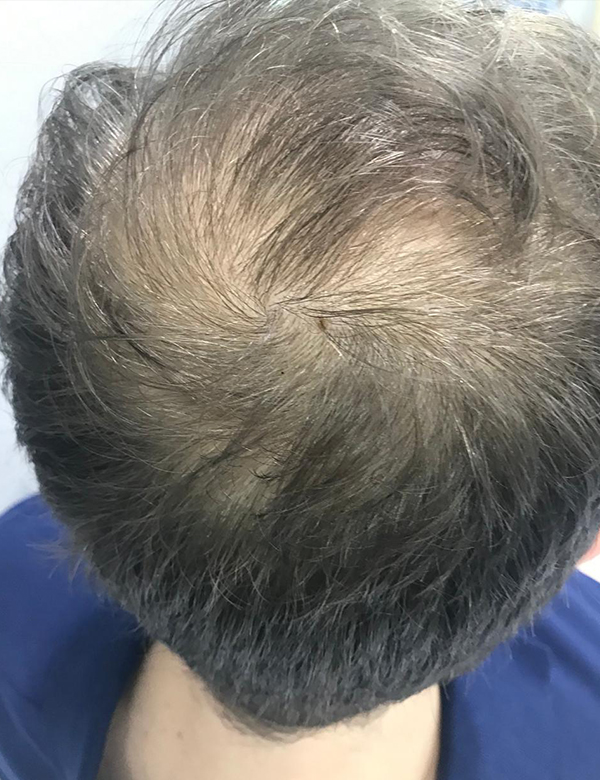 After hair regrowth treatment