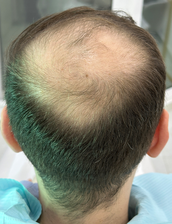 Before hair regrowth treatment