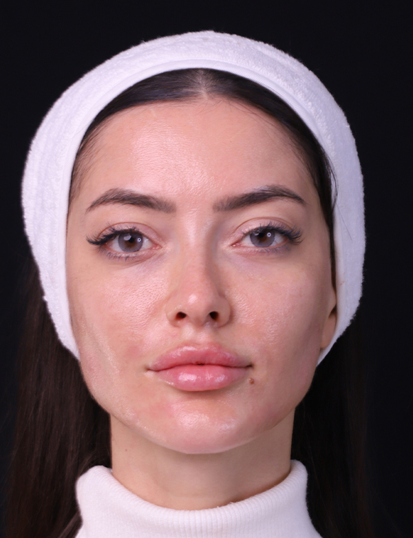 After rrs long lasting treatment