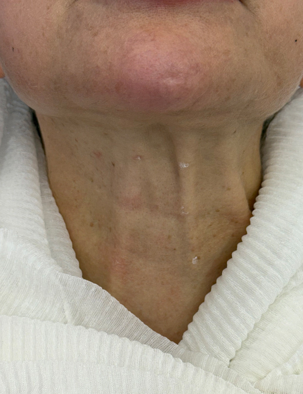 Before botox treatment