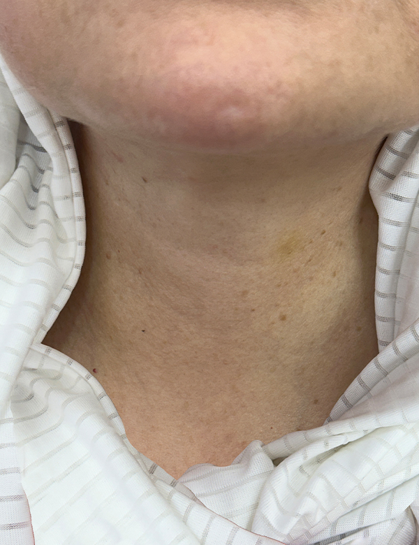 After botox treatment