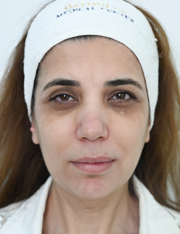 Before face transfprmation treatment