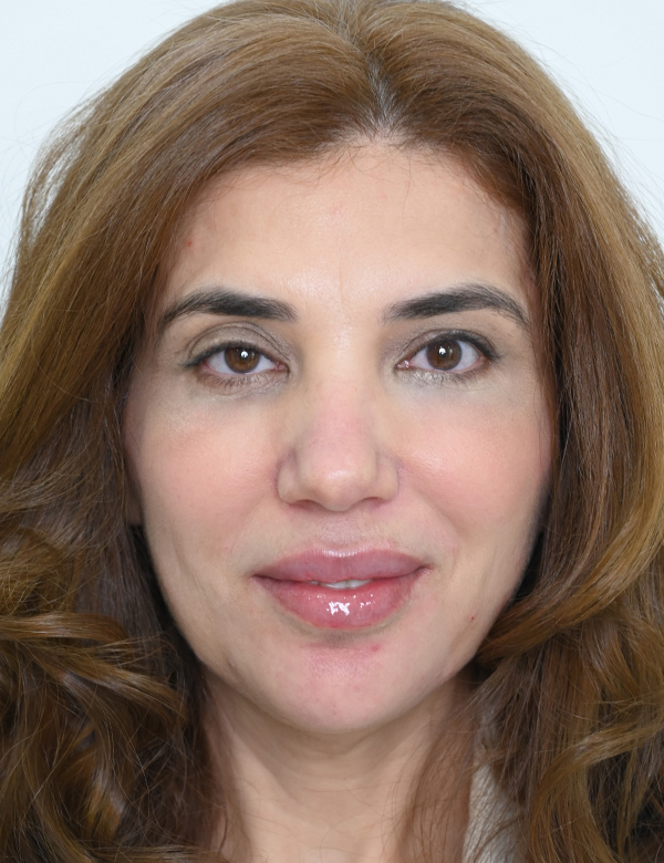 After face transfprmation treatment