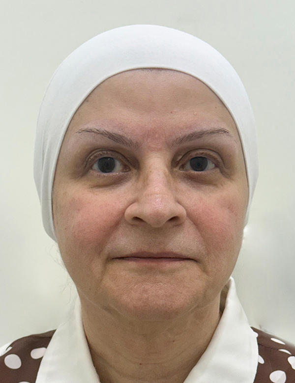 Before apollo quattro korean lifting treatment