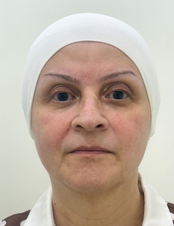 After apollo quattro korean lifting treatment