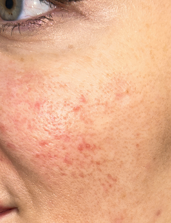 Before rosacea treatment treatment