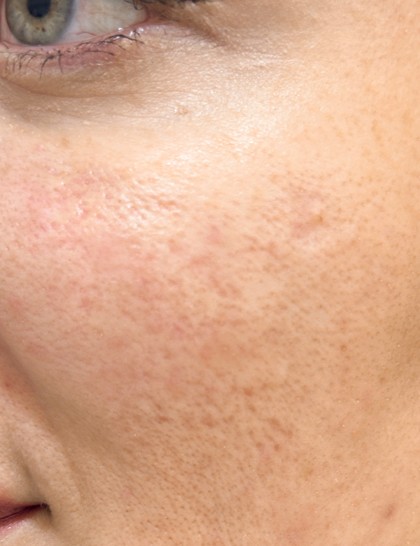 After rosacea treatment treatment