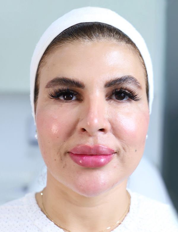 Before facial asymmetry correction treatment