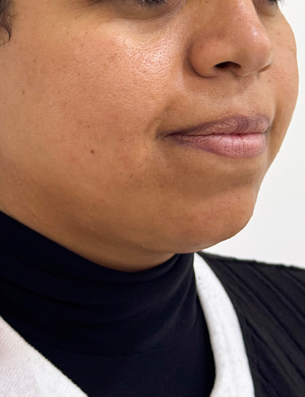 Before jawline & lips filler treatment