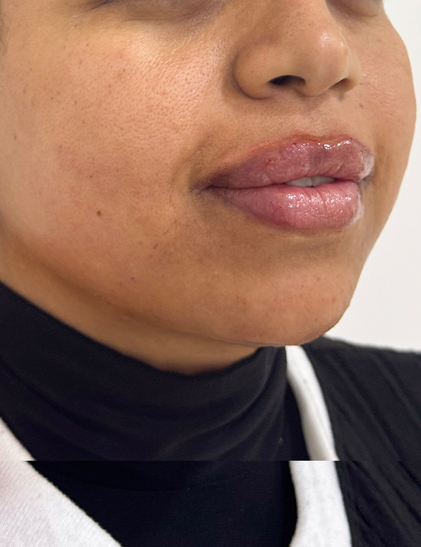 After jawline & lips filler treatment