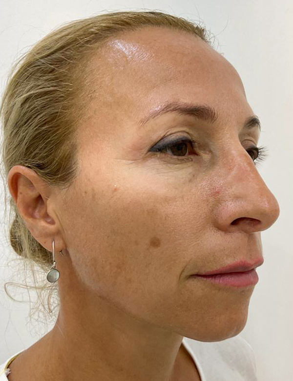 Before pigmentation treatment treatment