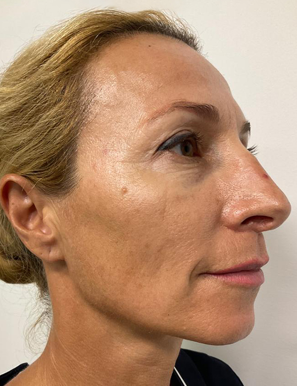 After pigmentation treatment treatment