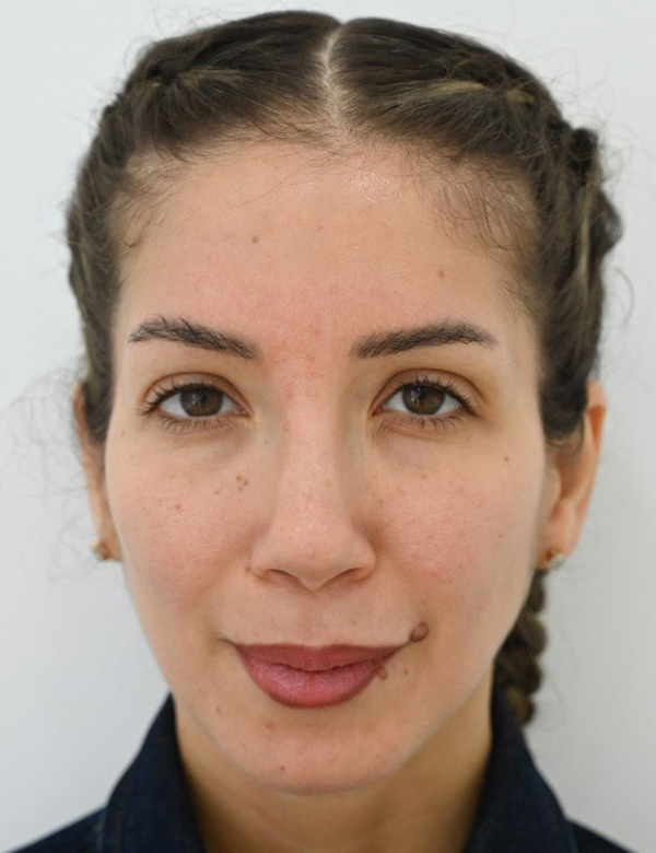 Before temples filler treatment