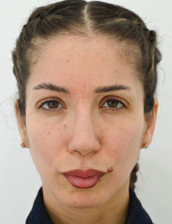 After temples filler treatment