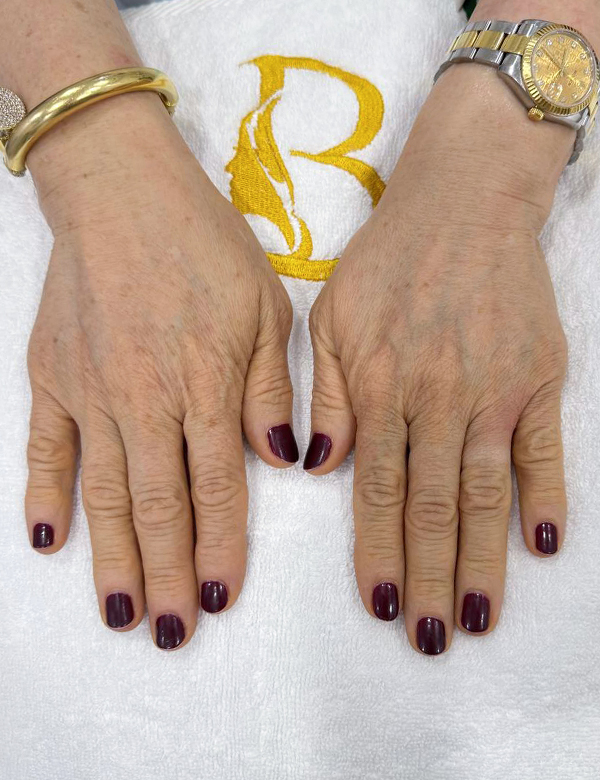 Before hands filler treatment
